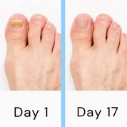 Nagellaserpilzgerät 3