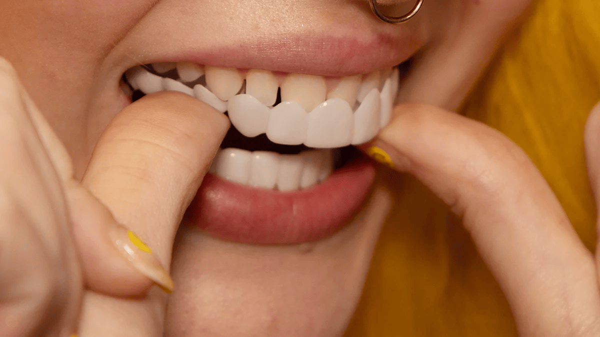Sofortige Lächelverwandlung mit Snap on Smile Veneers 6