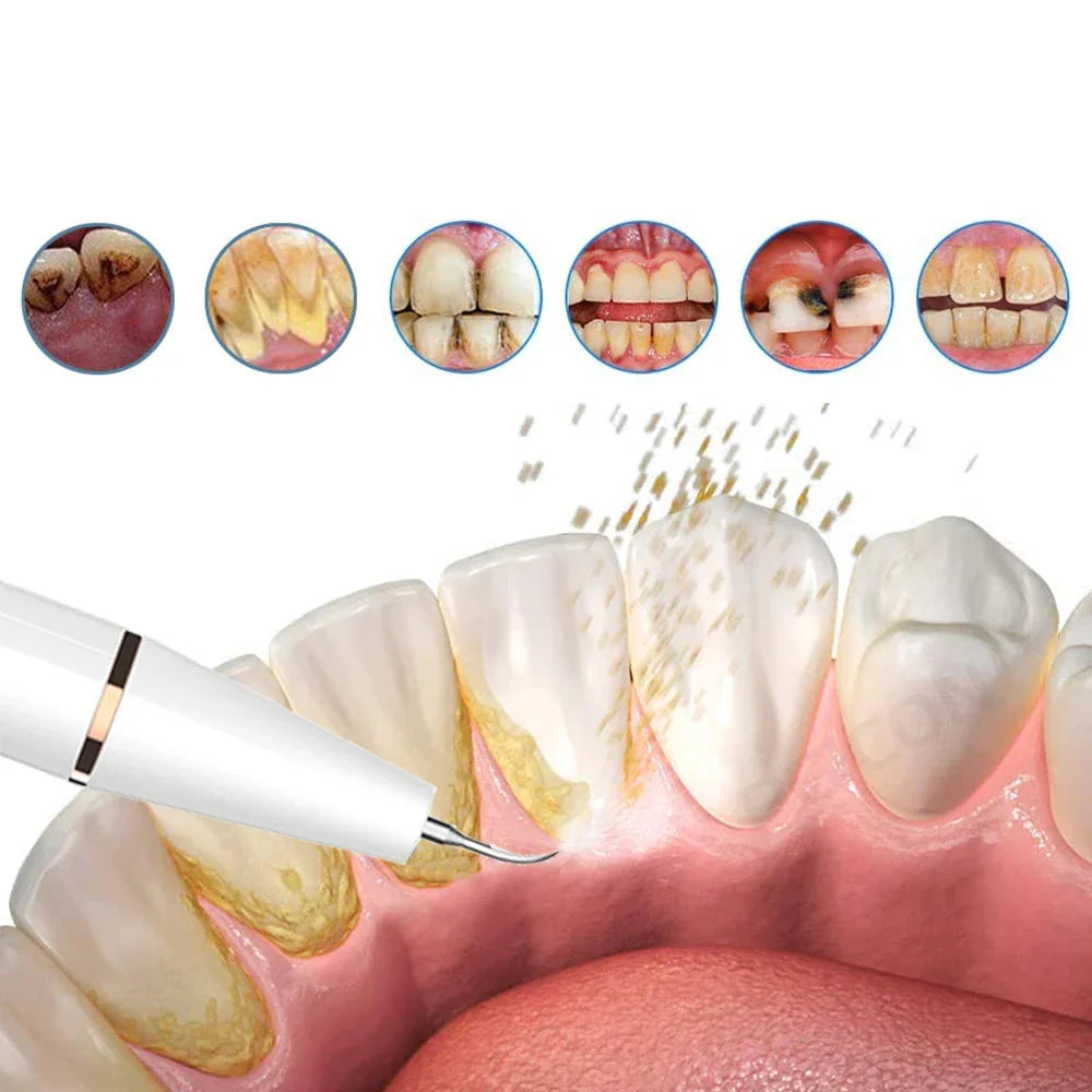 FreshScale - Ultraschall -Plaque & Tartar -Eliminator 1