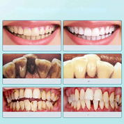 FreshScale - Ultraschall -Plaque & Tartar -Eliminator 2